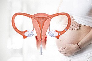Điều trị sinh sản: Thụ tinh trong tử cung (IUI)