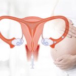 Điều trị sinh sản: Thụ tinh trong tử cung (IUI)